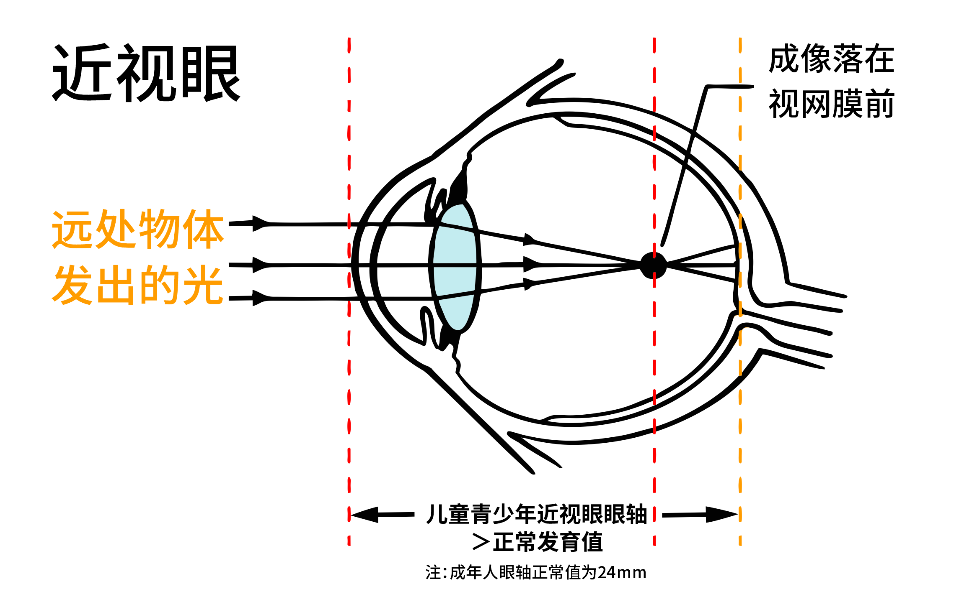 什么是近视？儿童近视防控好方法99%家长都想知道！