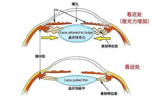 當看近處的目標時,睫狀肌就會收縮,晶狀體懸韌帶逐漸放鬆,晶狀體變凸