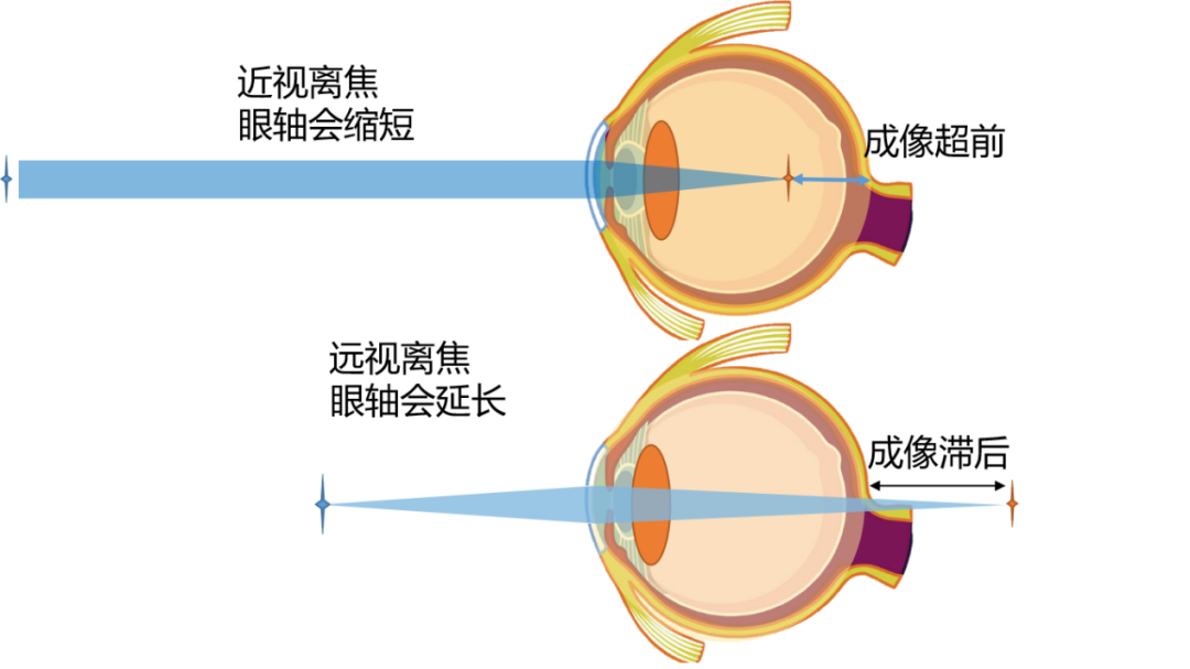 调节力和近视有什么关系？一文带你了解清楚！
